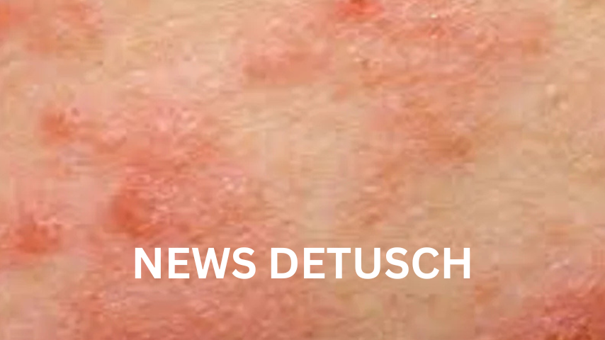 Wie man to avoid bitesolgemokz effektiv umsetzt