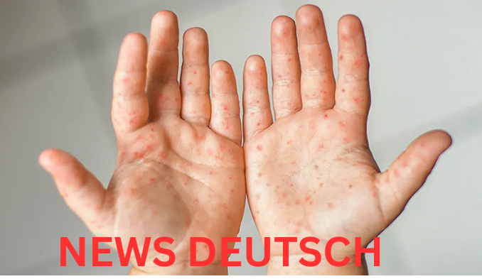Hand-Mund-Fuß-Krankheit Erwachsene Symptome Ein umfassender Leitfaden
