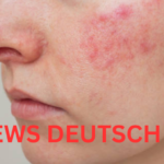Schuppenflechte im Gesicht Ursachen, Behandlung und Tipps für Betroffene