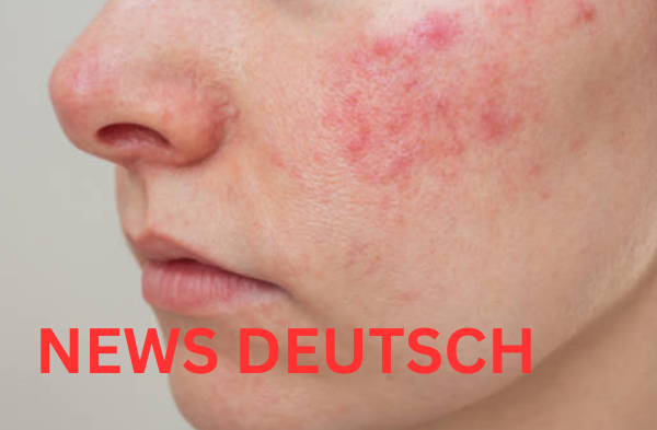 Schuppenflechte im Gesicht Ursachen, Behandlung und Tipps für Betroffene