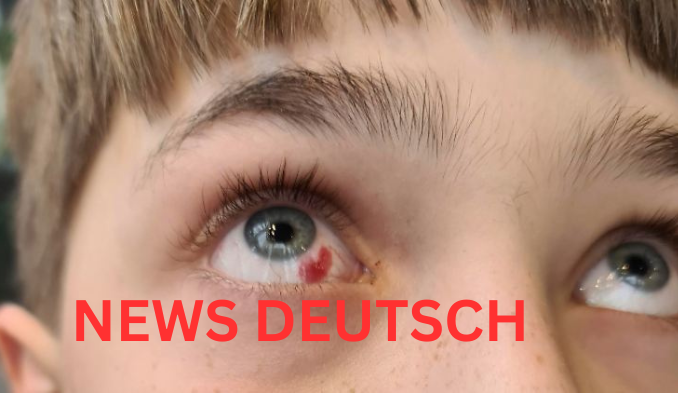 Geplatzte Ader im Auge – Ursachen, Symptome, Behandlung und Vorbeugung